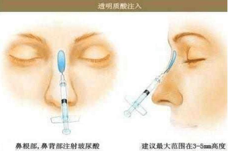 做玻尿酸隆鼻多少钱（玻尿酸隆鼻可以做吗） 第1张