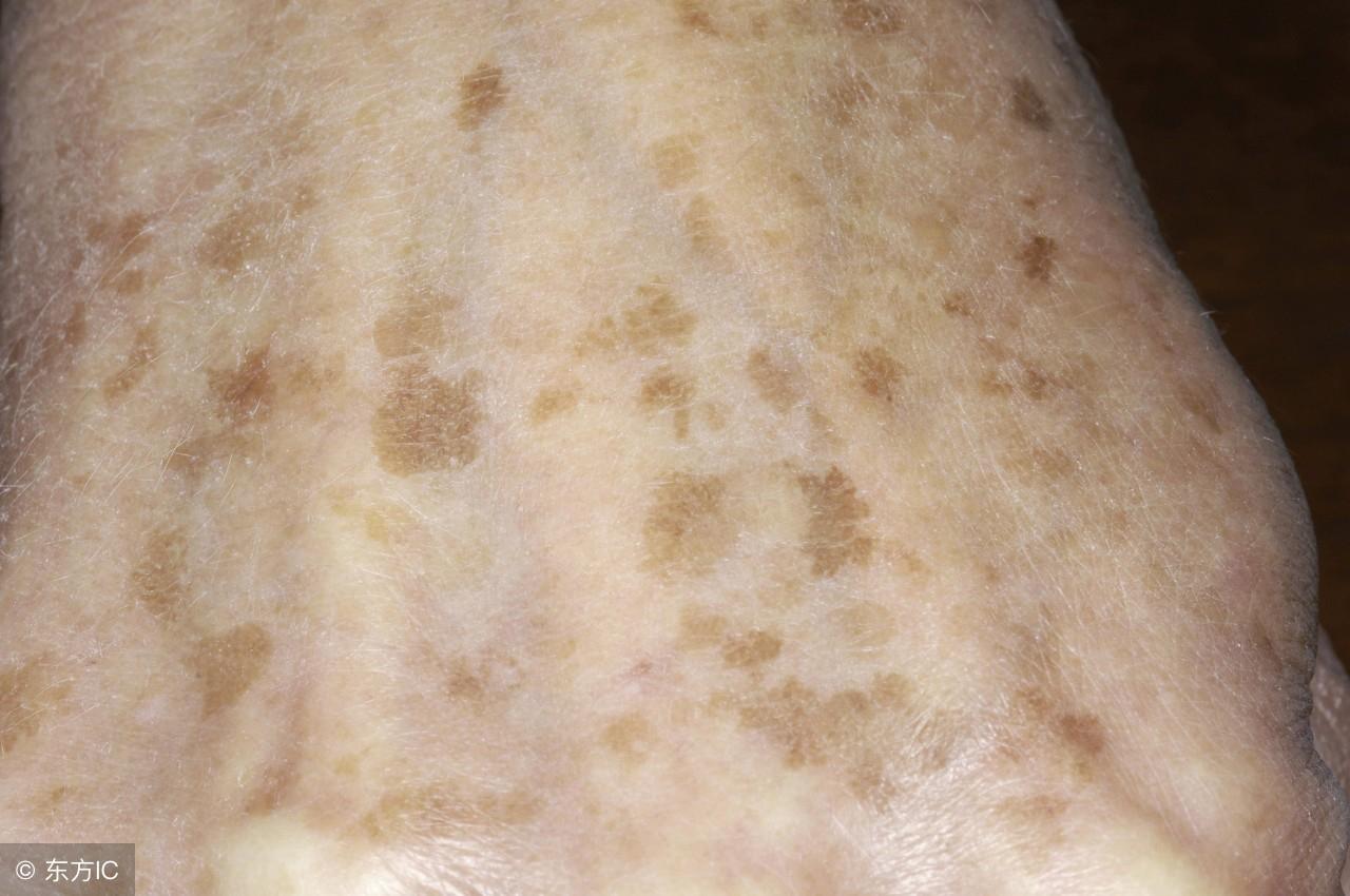 脸上长老年斑怎么办如何去除（老年斑消除最好的方法） 第1张