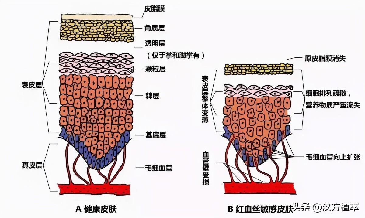 皮肤为什么会有红血丝（脸颊红血丝修复的方法） 第3张