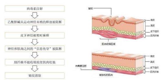 鱼尾纹怎么治疗最有效（治鱼尾纹的最佳方法） 第5张