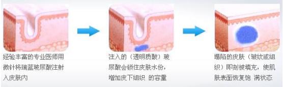 鱼尾纹怎么治疗最有效（治鱼尾纹的最佳方法） 第7张