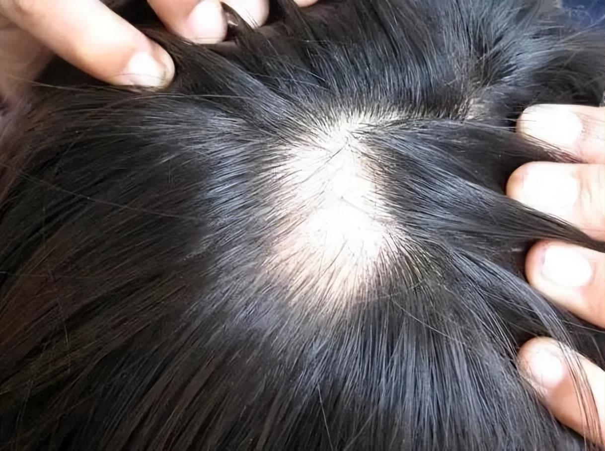 严重掉头发怎么治疗（生发的最好方法分享） 第7张