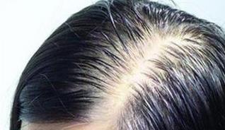 最近头发掉得很厉害怎么办（掉头发养回来的办法） 第5张