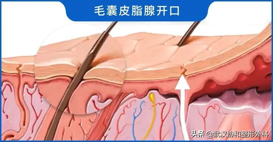 脸上的毛孔粗大是什么原因造成的（收缩毛孔最有效的办法） 第3张