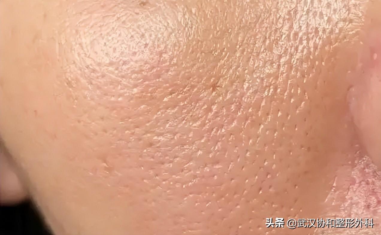 脸上的毛孔粗大是什么原因造成的（收缩毛孔最有效的办法） 第5张