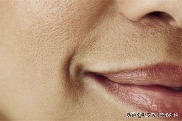 脸上的毛孔粗大是什么原因造成的（收缩毛孔最有效的办法） 第7张