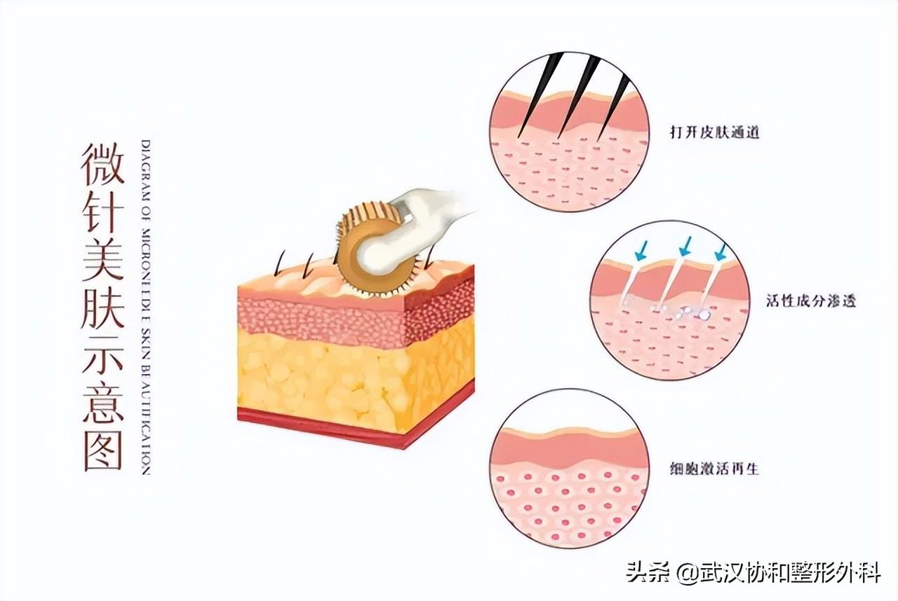 脸上的毛孔粗大是什么原因造成的（收缩毛孔最有效的办法） 第15张
