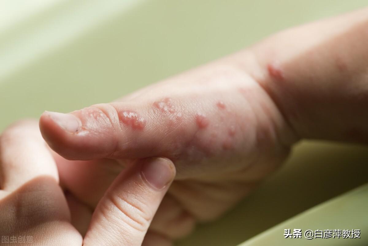 手指上有小水泡是怎么回事用什么药（长透明小水泡的原因） 第1张