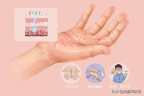 手指上有小水泡是怎么回事用什么药（长透明小水泡的原因） 第3张