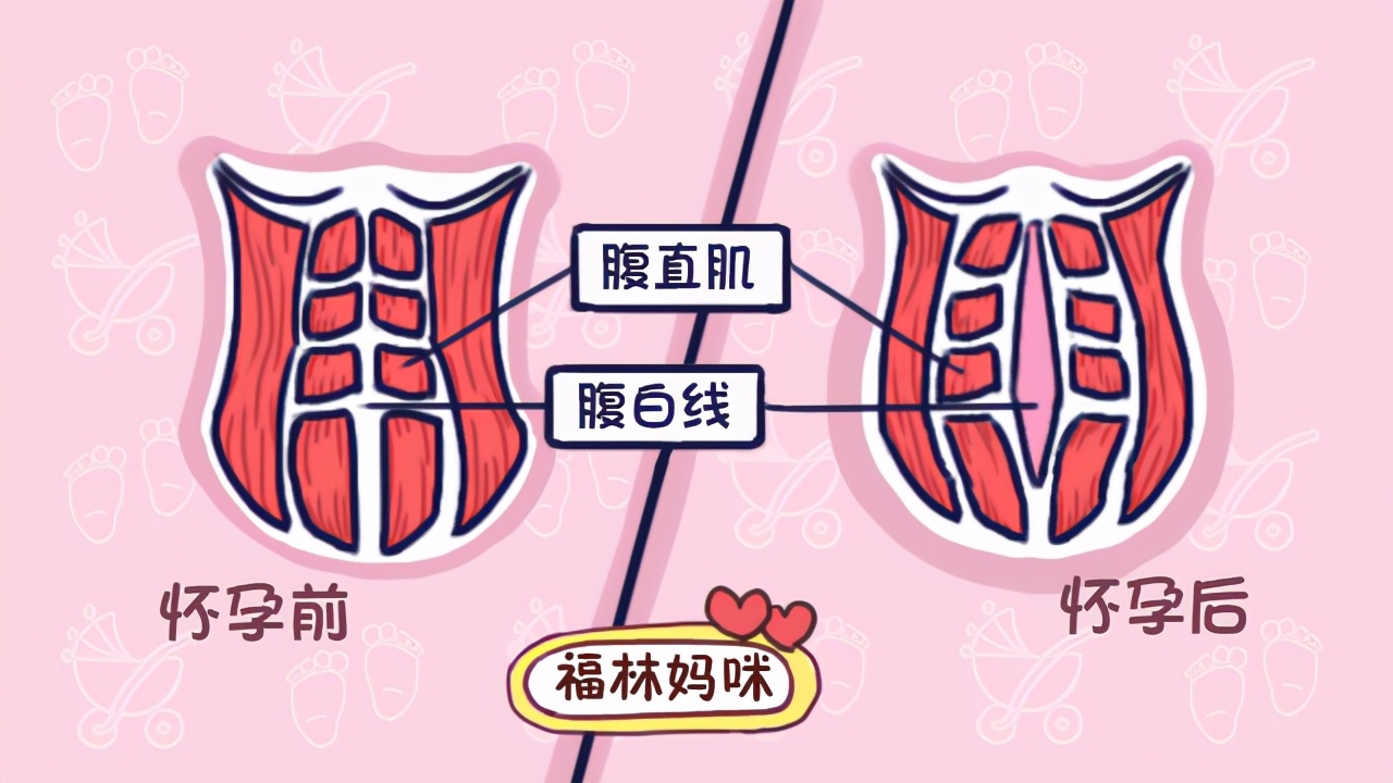 产后修复哪些有必要做，哪些没必要做？这篇文章帮你避坑 第11张